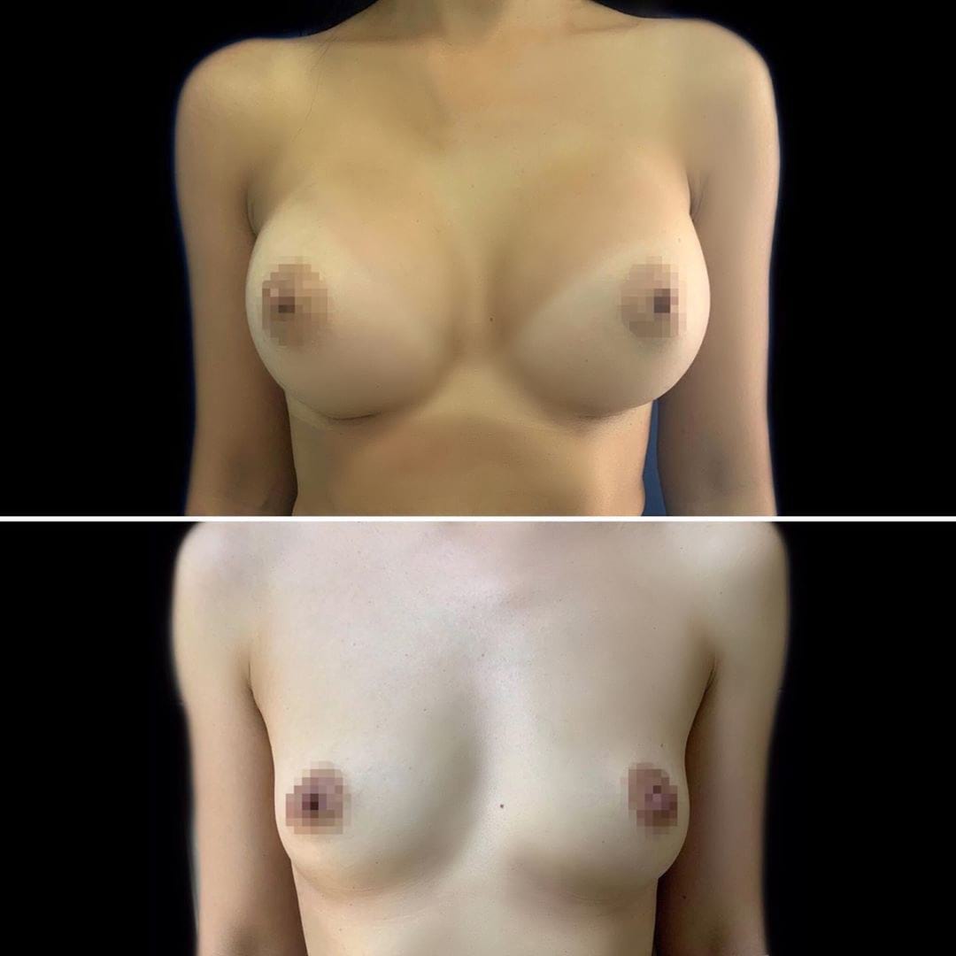увеличение груди фото до и после