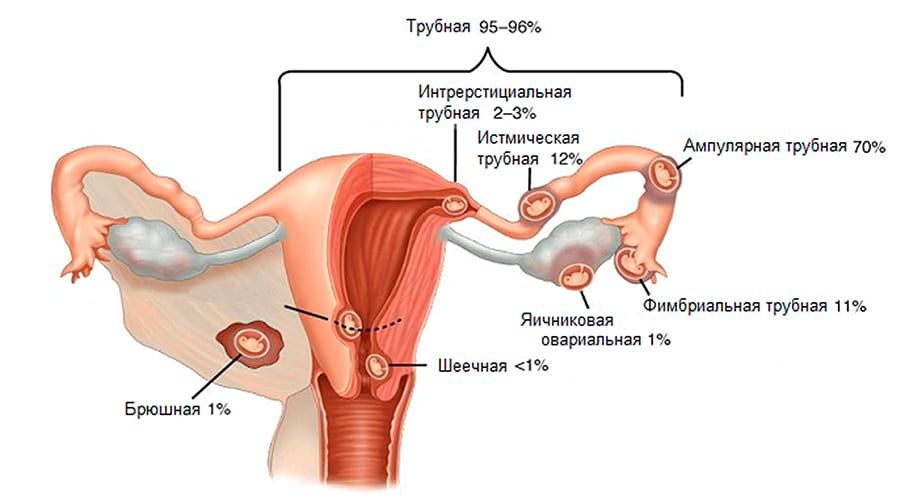 диагностика и виды внематочной беременности